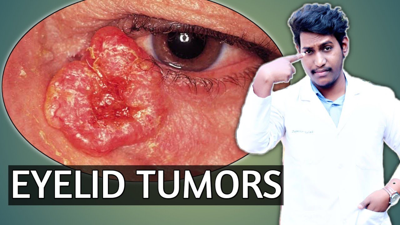 eyelid tumors ||tumors of eyelid in hindi ||eyelid cancer ||tumors of eyelid ~2021