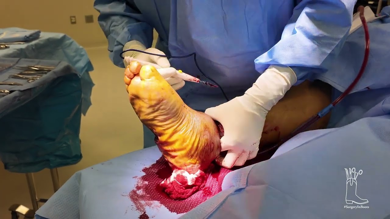 Part of leg Amputation