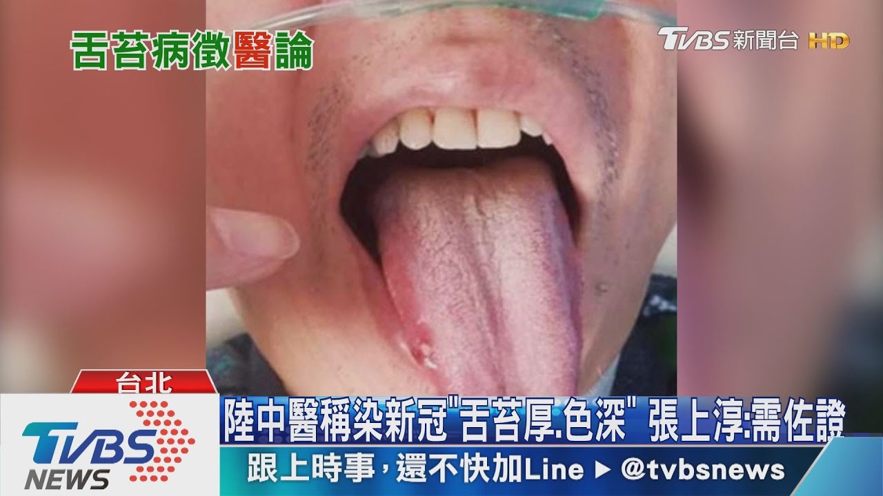 陸中醫稱染新冠 舌苔厚 色深 張上淳 需佐證 新冠肺炎 把脈 病症 Tvbs新聞網