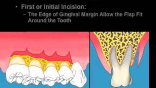 Distal Molar Surgery part 2.mov