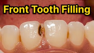Fixing A Cavity On A Front Tooth