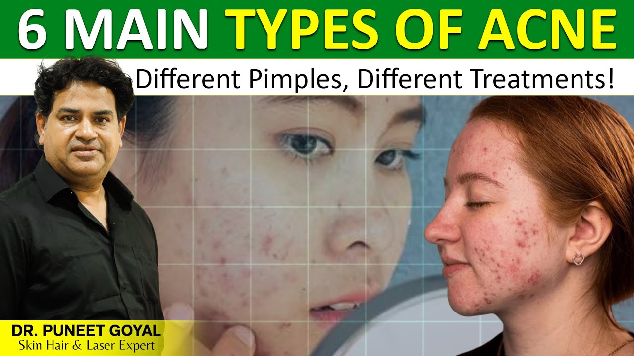 6 Main Types of Acne | Causes, Symptoms & Treatment Explained in Detail