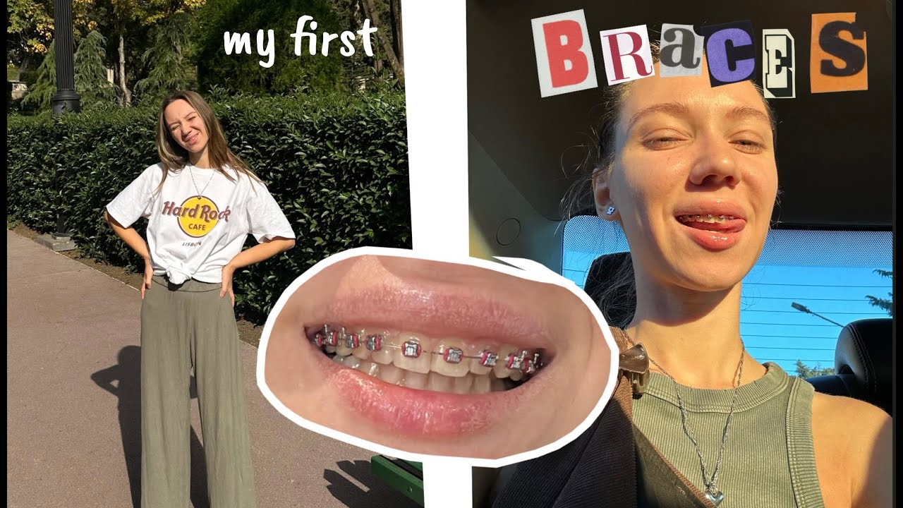 поставила брекеты | мои ощущения на второй день | какие брекеты выбрать ...