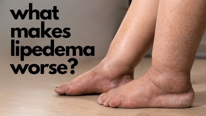 TalkLipoedema on X: Make sure that you find the best conservative  treatments that help you. Remember we all suffer with this chronic disease  but it presents itself differently in each person, “we