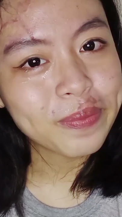 Menghilangkan bekas luka jahitan