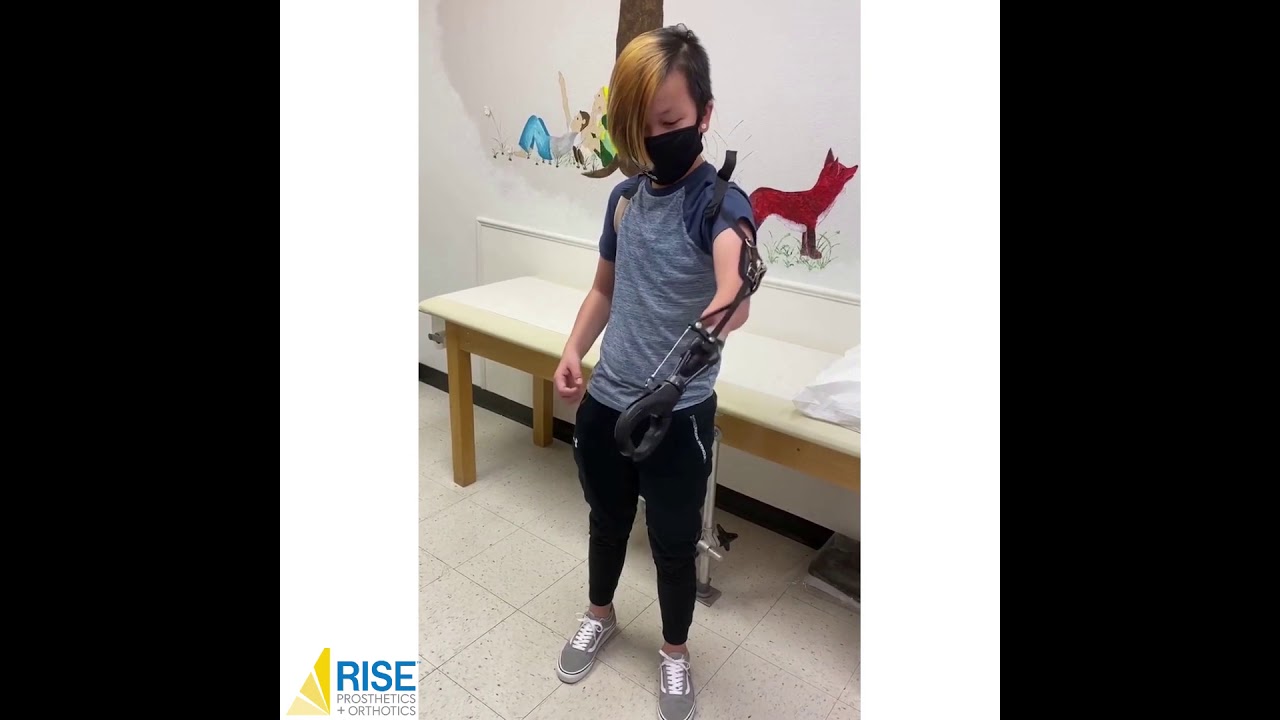 🙌🎉🎉   Kevin is thrilled with his first prosthesis.