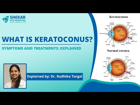 What is Keratoconus? Causes and Treatment options : Explained