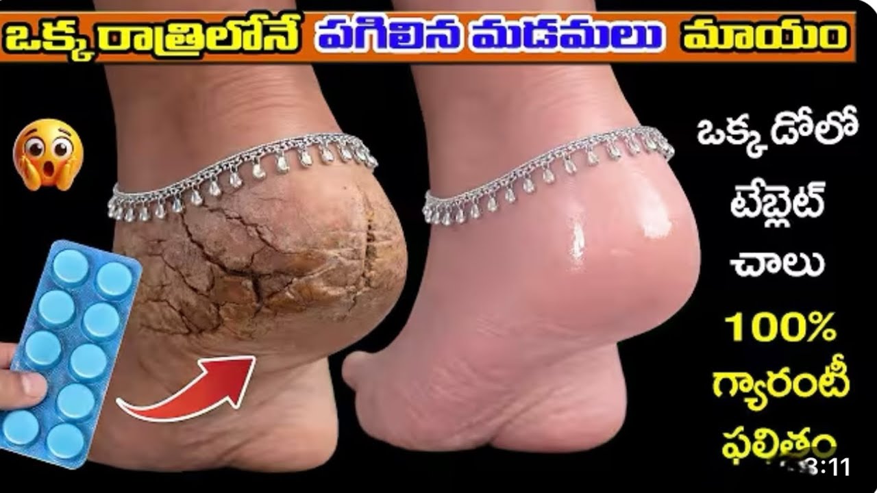 రాత్రికి రాత్రె కళ్ళ పగుళ్లు మాయం మీరు దీన్ని వాడారంటే రిజల్ట్ 😳🥺👍🤷🏻‍♀️@amshortsandvideos 