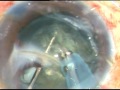 Cataract with adherent leucoma iridocorneolenticular adhesion  p mohanta