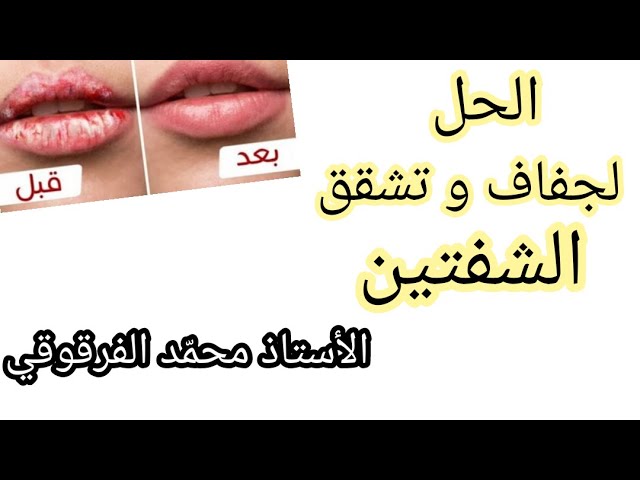 الحل لجفاف و تشقق الشفتين