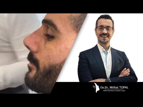 Open Preservation Rhinoplasty