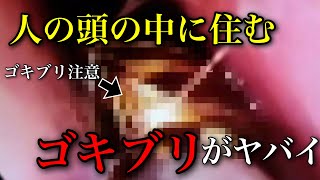 【閲覧注意】人間の頭の中に住むゴキブリ!?人の体から発見されたゴキブリ達