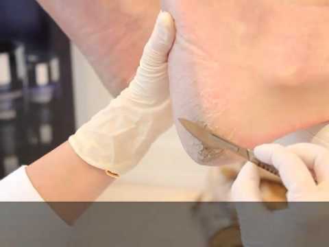 Video: Mycosis I Hud, Negle Og Fødder - Symptomer Og Behandling Af Mycosis