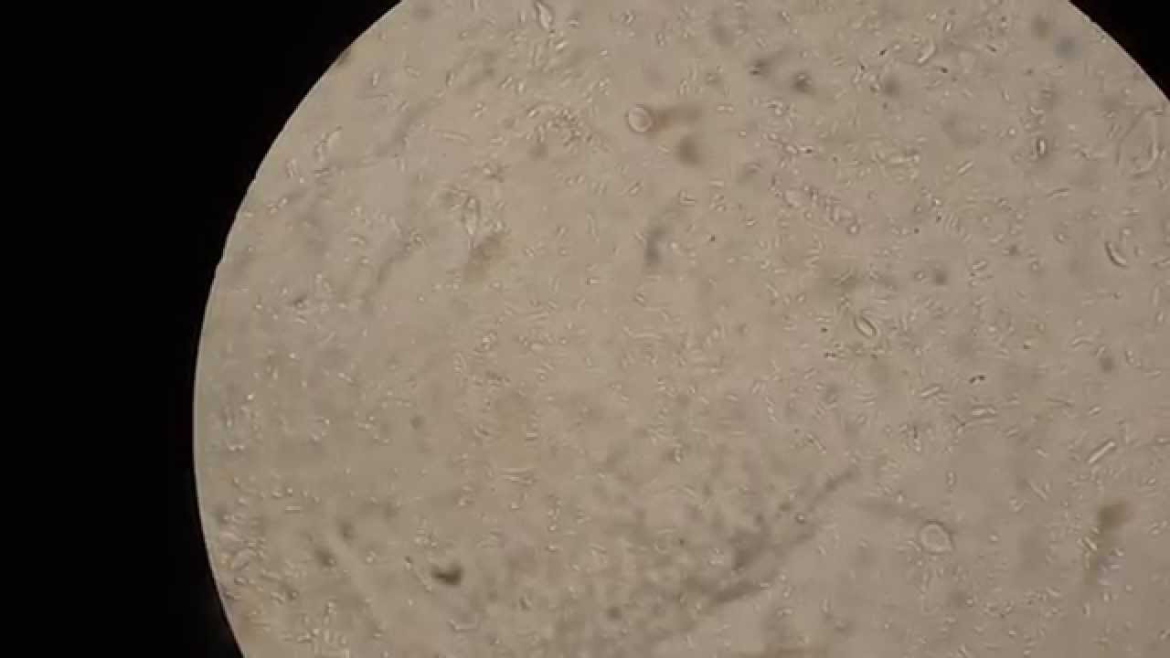 Los parásitos el intestino de la persona de la foto