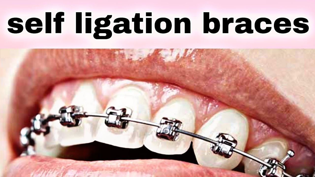 self ligating braces / malayalam/ pallil kambi idunnath / pallil kambi