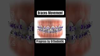 Braces Movement progression