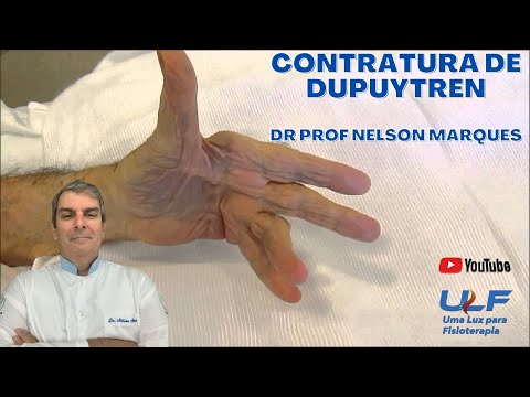 CONTRATURA DE DUPUYTREN