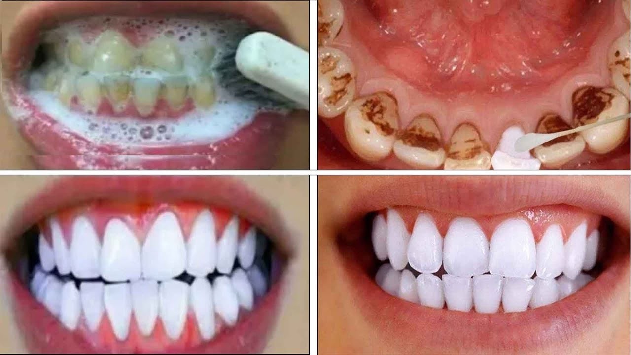 Remove Black Stains on Teeth at Home in 3 Minutes | Natural Teeth