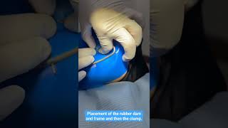 Placement of the rubber dam and frame and then the clamp.         #endodontics #rubberdam #apexlore screenshot 4