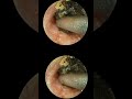 I show speed⚫ Black Head 🤗 😎Wax Part 4 #shorts #pimplepopping #asmr #pimple #relax #satisfy #usa