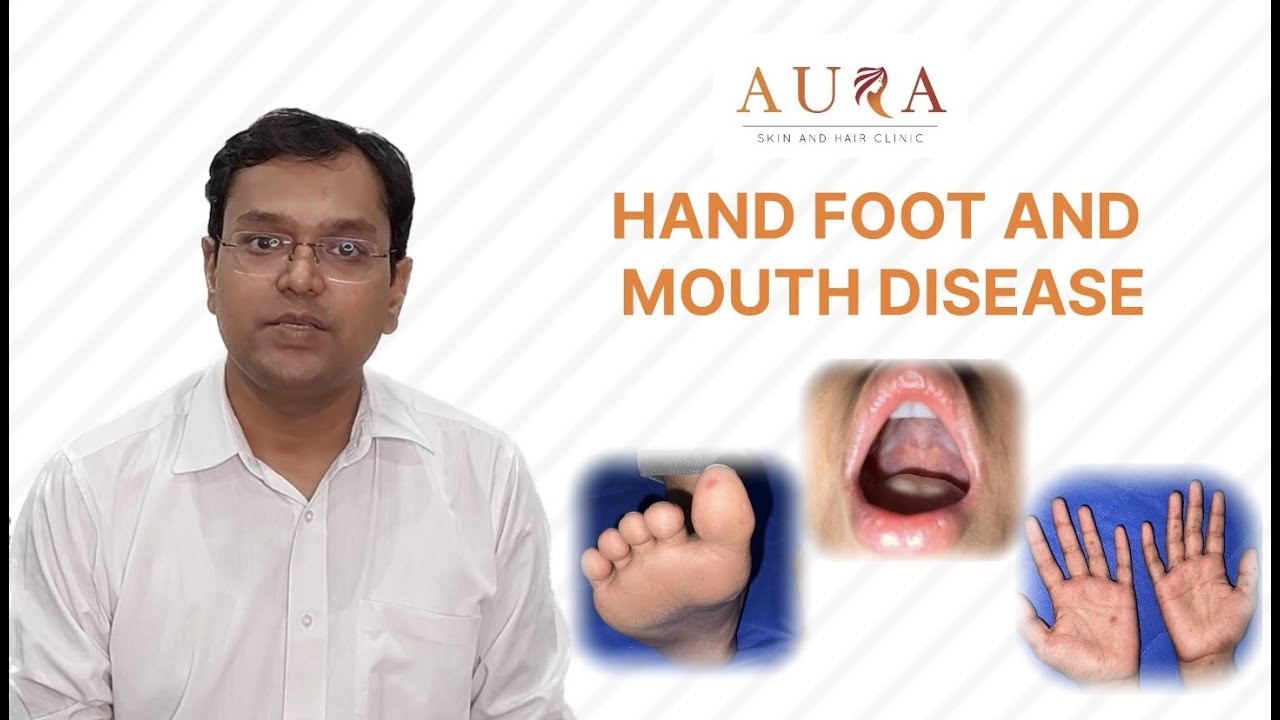 Understanding Hand, Foot, and Mouth Disease A common skin rash in