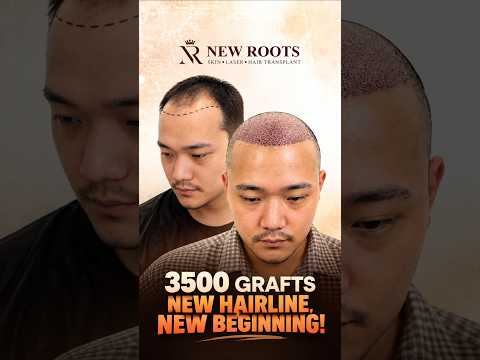 3500 Grafts Hair Transplant | New Hairline Transformation | New Roots Siliguri