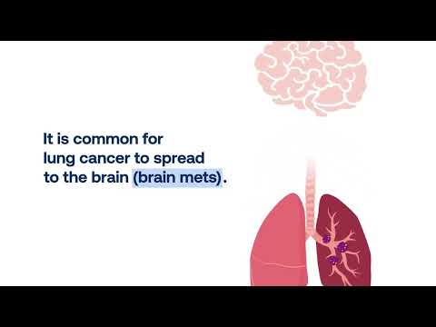 Brain Mets and Lung Cancer: Quick Fact