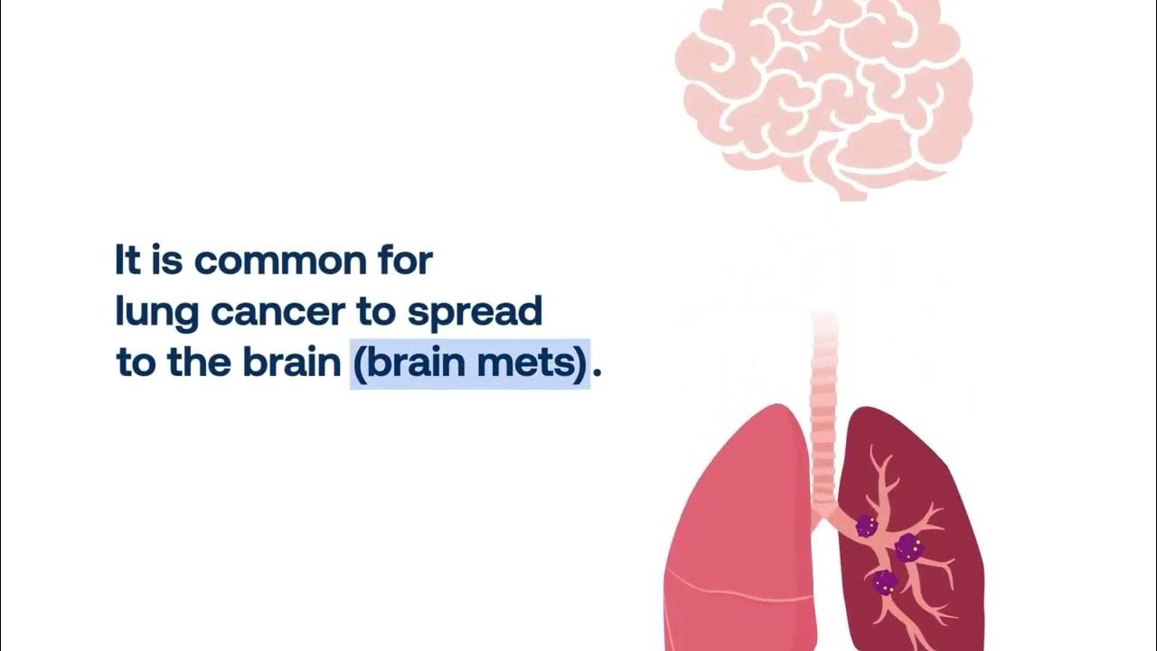 Lung Cancer Brain Mets Symptoms