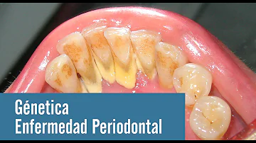 ¿Es hereditaria la enfermedad periodontal?