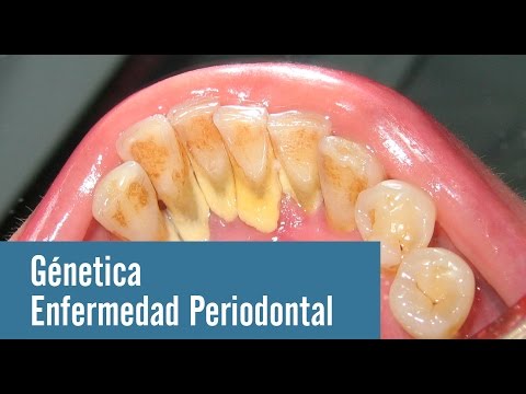 Vídeo: La Enfermedad Periodontal Resultó Ser La Causa De Tumores Cancerosos - Vista Alternativa