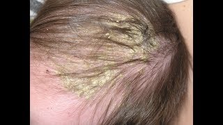 Cradle cap, medically known as infantile seborrheic dermatitis, is a common skin problem among babies. It is characterized by 