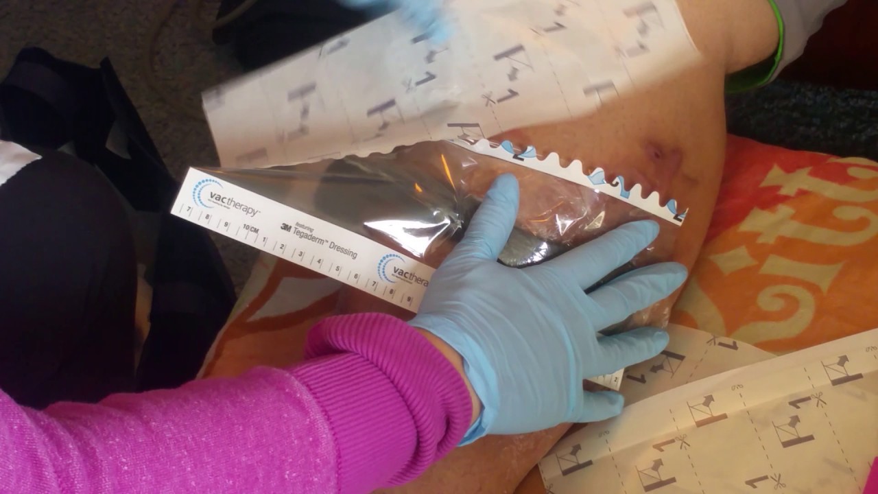 Meet my inhome nurse Teresa, as she changes my Wound VAC!!! YouTube