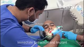 Immediate Extraction And Implant By Dr Aaditya Patakrao