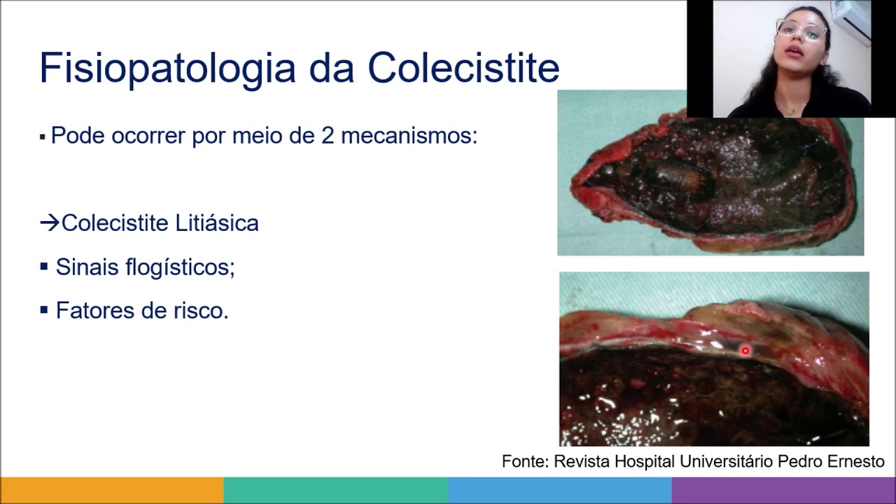 Litíase Biliar e Colecistite Saúde do Adulto YouTube Litíase Biliar e Colecistite Saúde do Adulto YouTube