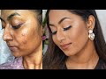 HOW TO COVER ACNE PRONE SKIN & HYPERPIGMENTATION ✨ | Flawless Full Coverage Base |