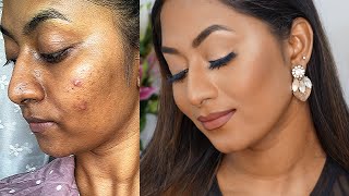 HOW TO COVER ACNE PRONE SKIN & HYPERPIGMENTATION ✨ | Flawless Full Coverage Base | screenshot 2