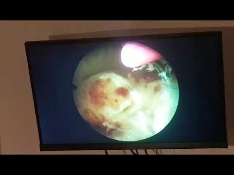Video: Histeroskopsko Uklanjanje Polipa Endometrija