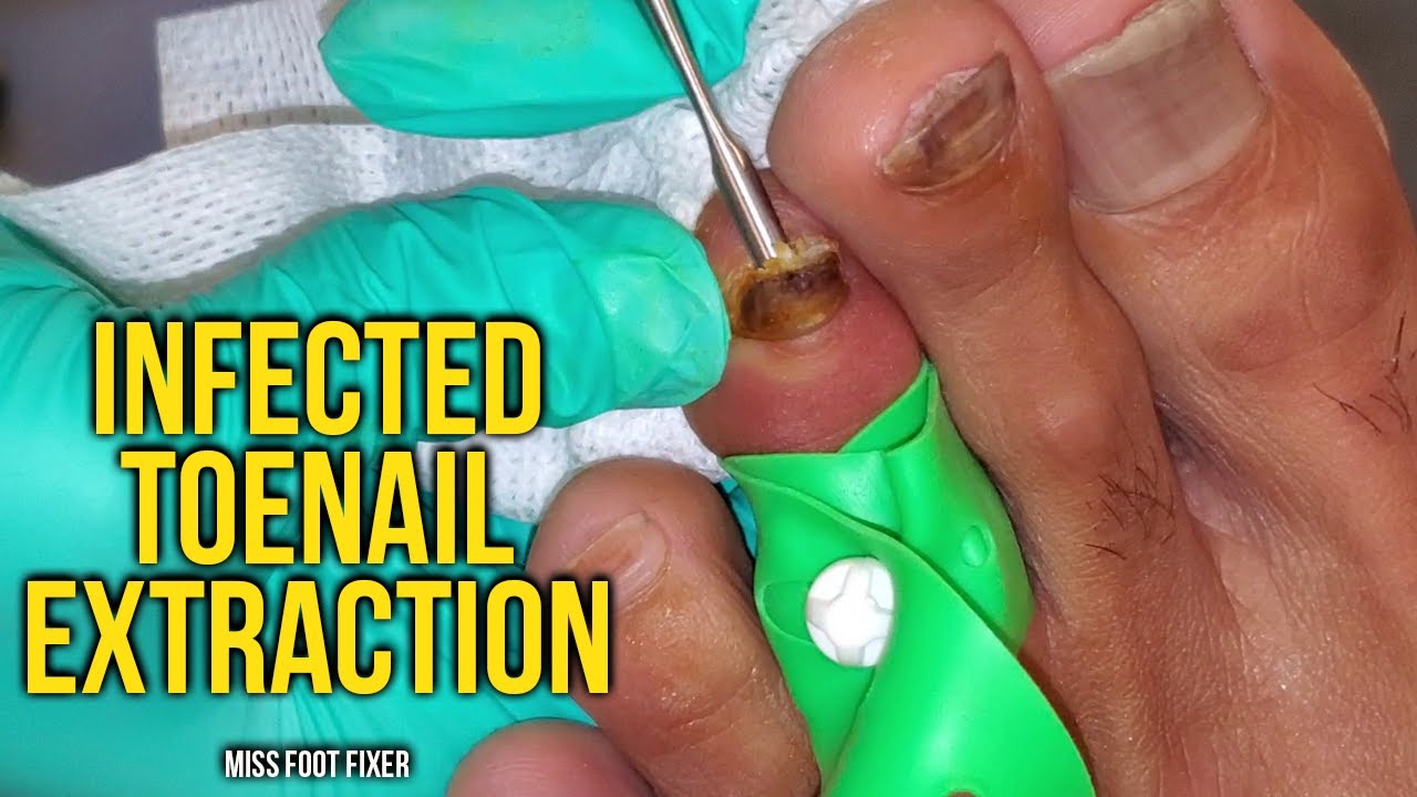 Infected Toenail EXTRACTION *** Toe Injured BEST Treatment! by miss