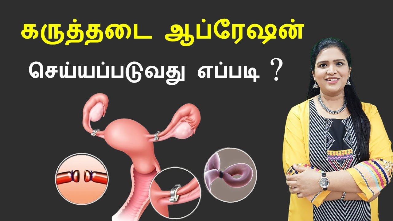 குடும்பக் கட்டுப்பாடு அறுவை சிகிச்சை முறைகள் | Female Sterilization-Tubectomy