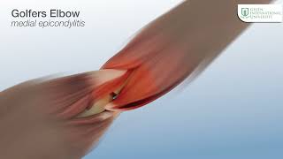 Golfer's elbow - 3D Animation | Admissions Open - Spring 2024 | @studyatgiu