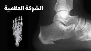 الشوكة العظمية او مسمار كعب القدم و علاجها - معلومات تسمعها للمرة الأولى. تفادى حدوث التشوه العظمي