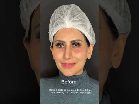 Ellanse Collagen Stimulator Filler