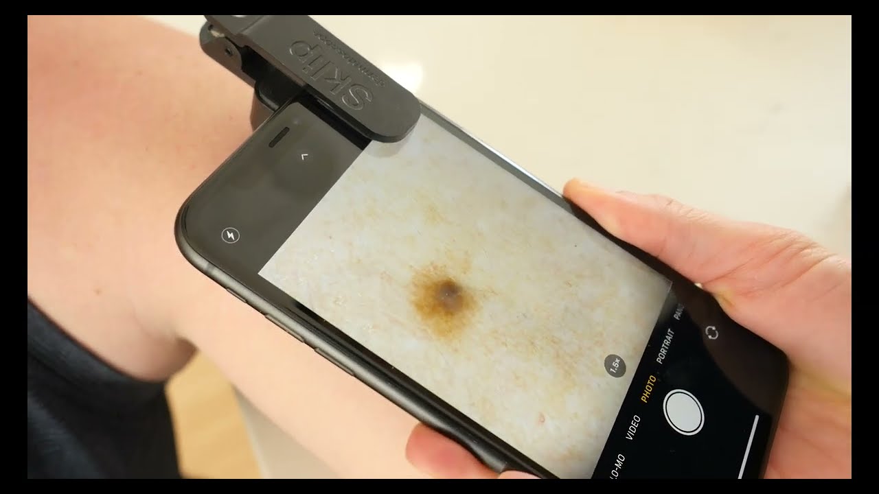 SKLIP Dermatoscope Demonstration Video