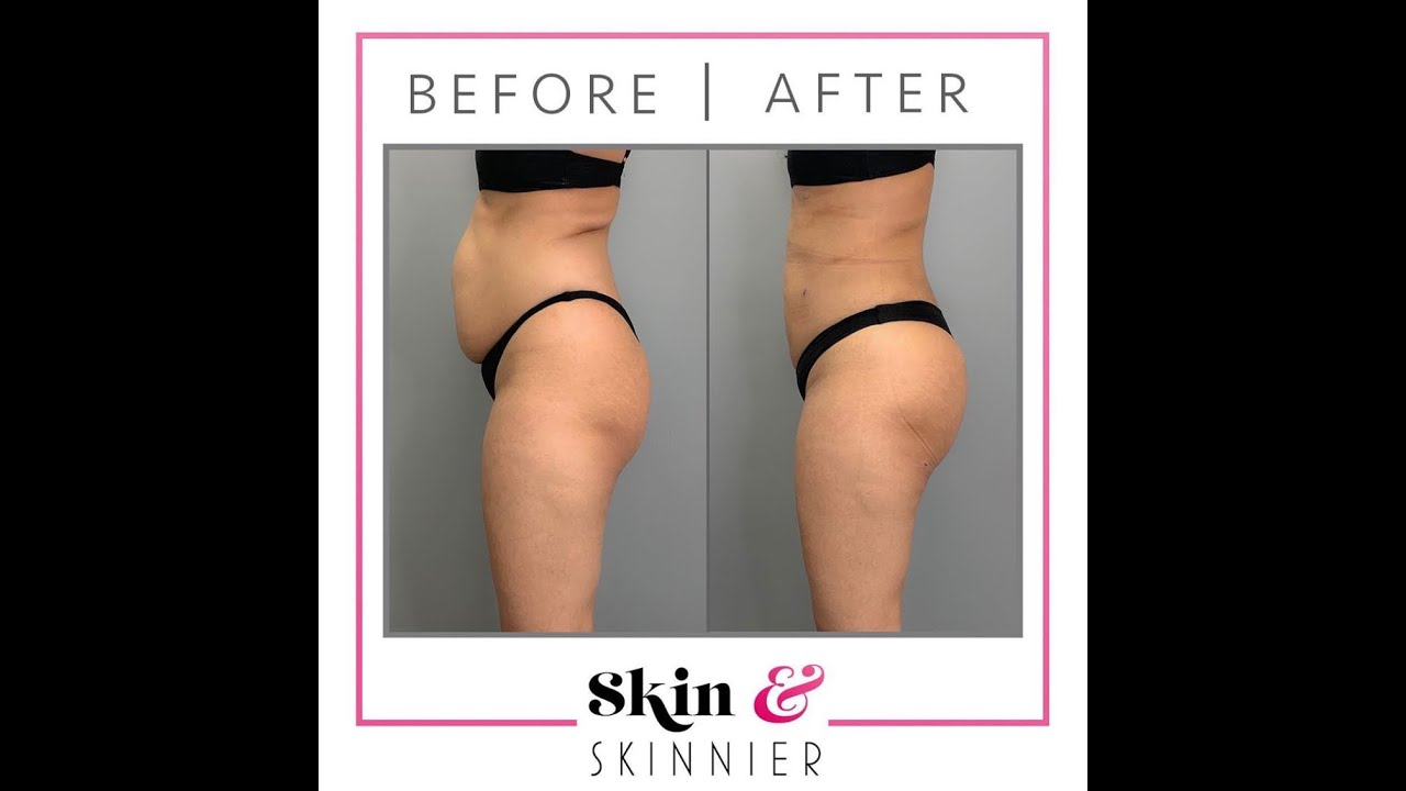 Do you really need a tummy tuck?