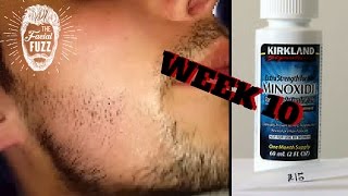 Minoxidil Beard | Week 10 | Minoxidil 5% for Beard Growth | #FacialFuzzFridays