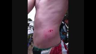 BMX injuries