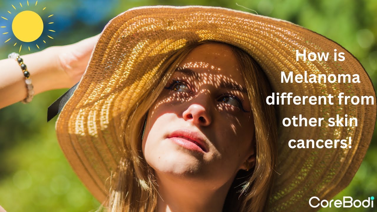 How is melanoma different from other skin cancers (The vital signs ...