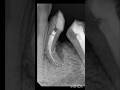 ReRct of 34 and 35 #rct #premolar #shortvideo #endodontics