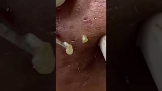 acne blackhead pimple satisfying blackheads pimpleremoval fyp  ID Video 7244105022152117531