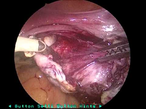 Laparoscopic removal of dermoid cyst of ovary